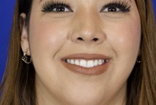 Rhinoplasty After Photo by Thanapoom Boonipat, MD; Lubbock, TX - Case 51434