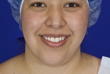 Rhinoplasty Before Photo by Thanapoom Boonipat, MD; Lubbock, TX - Case 51434