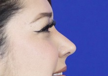Rhinoplasty After Photo by Thanapoom Boonipat, MD; Lubbock, TX - Case 51434