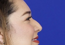 Rhinoplasty Before Photo by Thanapoom Boonipat, MD; Lubbock, TX - Case 51434