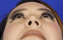 Rhinoplasty After Photo by Thanapoom Boonipat, MD; Lubbock, TX - Case 51434
