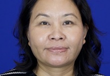 Liposuction After Photo by Thanapoom Boonipat, MD; Lubbock, TX - Case 51445