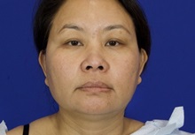 Liposuction Before Photo by Thanapoom Boonipat, MD; Lubbock, TX - Case 51445