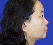 Liposuction After Photo by Thanapoom Boonipat, MD; Lubbock, TX - Case 51445