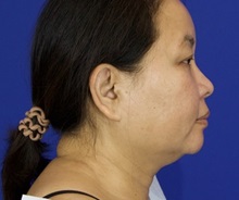Liposuction Before Photo by Thanapoom Boonipat, MD; Lubbock, TX - Case 51445