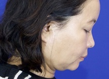 Liposuction After Photo by Thanapoom Boonipat, MD; Lubbock, TX - Case 51445