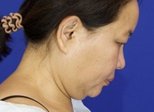Liposuction Before Photo by Thanapoom Boonipat, MD; Lubbock, TX - Case 51445