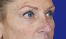 Eyelid Surgery After Photo by Thanapoom Boonipat, MD; Lubbock, TX - Case 51447