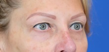 Eyelid Surgery Before Photo by Thanapoom Boonipat, MD; Lubbock, TX - Case 51447