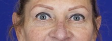 Eyelid Surgery After Photo by Thanapoom Boonipat, MD; Lubbock, TX - Case 51447