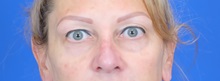 Eyelid Surgery Before Photo by Thanapoom Boonipat, MD; Lubbock, TX - Case 51447