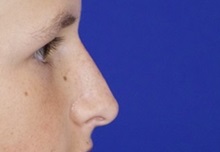 Injectable Fillers and Fat Transfer to the Face After Photo by Thanapoom Boonipat, MD; Lubbock, TX - Case 51441