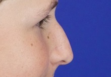 Injectable Fillers and Fat Transfer to the Face Before Photo by Thanapoom Boonipat, MD; Lubbock, TX - Case 51441