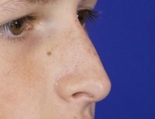 Injectable Fillers and Fat Transfer to the Face After Photo by Thanapoom Boonipat, MD; Lubbock, TX - Case 51441
