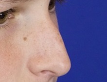 Injectable Fillers and Fat Transfer to the Face Before Photo by Thanapoom Boonipat, MD; Lubbock, TX - Case 51441
