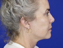 Facelift After Photo by Thanapoom Boonipat, MD; Lubbock, TX - Case 51443