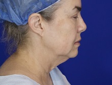 Facelift Before Photo by Thanapoom Boonipat, MD; Lubbock, TX - Case 51443