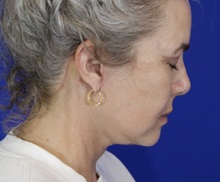 Facelift After Photo by Thanapoom Boonipat, MD; Lubbock, TX - Case 51443