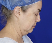 Facelift Before Photo by Thanapoom Boonipat, MD; Lubbock, TX - Case 51443