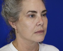 Facelift After Photo by Thanapoom Boonipat, MD; Lubbock, TX - Case 51443