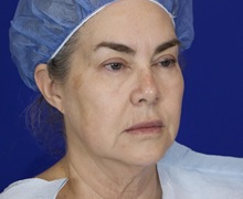 Facelift Before Photo by Thanapoom Boonipat, MD; Lubbock, TX - Case 51443
