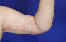 Arm Lift After Photo by Thanapoom Boonipat, MD; Lubbock, TX - Case 51444
