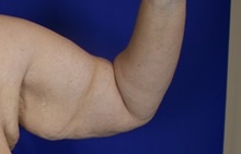 Arm Lift Before Photo by Thanapoom Boonipat, MD; Lubbock, TX - Case 51444