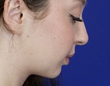 Chin Augmentation After Photo by Thanapoom Boonipat, MD; Lubbock, TX - Case 51446