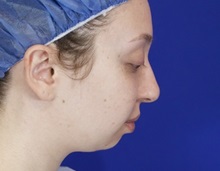 Chin Augmentation Before Photo by Thanapoom Boonipat, MD; Lubbock, TX - Case 51446