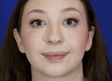 Chin Augmentation After Photo by Thanapoom Boonipat, MD; Lubbock, TX - Case 51446