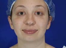 Chin Augmentation Before Photo by Thanapoom Boonipat, MD; Lubbock, TX - Case 51446