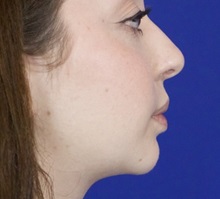 Chin Augmentation After Photo by Thanapoom Boonipat, MD; Lubbock, TX - Case 51446