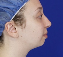 Chin Augmentation Before Photo by Thanapoom Boonipat, MD; Lubbock, TX - Case 51446