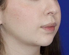 Chin Augmentation After Photo by Thanapoom Boonipat, MD; Lubbock, TX - Case 51446