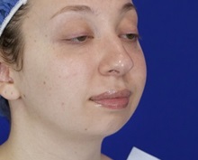 Chin Augmentation Before Photo by Thanapoom Boonipat, MD; Lubbock, TX - Case 51446
