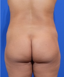 Tummy Tuck Before Photo by Thanapoom Boonipat, MD; Lubbock, TX - Case 51459