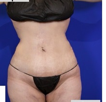 Liposuction After Photo by Thanapoom Boonipat, MD; Lubbock, TX - Case 51458