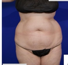 Liposuction Before Photo by Thanapoom Boonipat, MD; Lubbock, TX - Case 51458