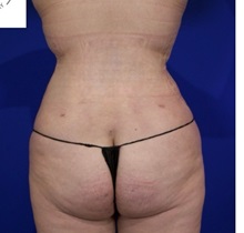 Liposuction After Photo by Thanapoom Boonipat, MD; Lubbock, TX - Case 51458