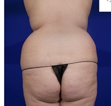 Liposuction Before Photo by Thanapoom Boonipat, MD; Lubbock, TX - Case 51458