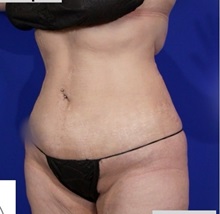 Liposuction After Photo by Thanapoom Boonipat, MD; Lubbock, TX - Case 51458