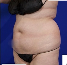 Liposuction Before Photo by Thanapoom Boonipat, MD; Lubbock, TX - Case 51458