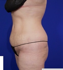 Liposuction After Photo by Thanapoom Boonipat, MD; Lubbock, TX - Case 51458