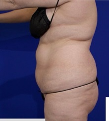 Liposuction Before Photo by Thanapoom Boonipat, MD; Lubbock, TX - Case 51458