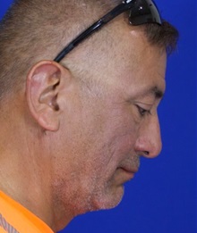 Facelift After Photo by Thanapoom Boonipat, MD; Lubbock, TX - Case 51460