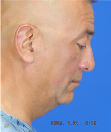 Facelift Before Photo by Thanapoom Boonipat, MD; Lubbock, TX - Case 51460