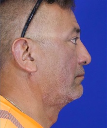 Facelift After Photo by Thanapoom Boonipat, MD; Lubbock, TX - Case 51460