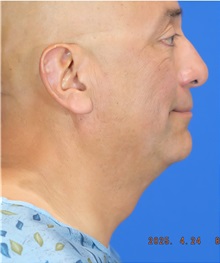 Facelift Before Photo by Thanapoom Boonipat, MD; Lubbock, TX - Case 51460