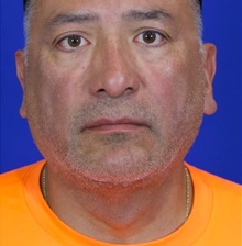 Facelift After Photo by Thanapoom Boonipat, MD; Lubbock, TX - Case 51460