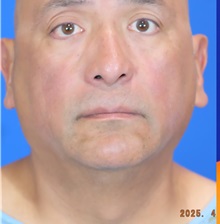 Facelift Before Photo by Thanapoom Boonipat, MD; Lubbock, TX - Case 51460